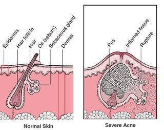 Natural Acne Care