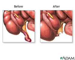 Living without an appendix causes no known health problems.