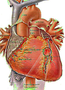 Arteriosclerosis is the hardening and loss of elasticity of medium or large arteries