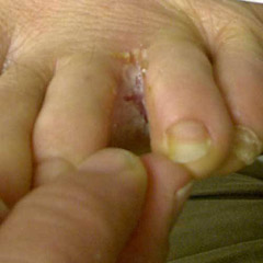 This is an example of chronic interdigital athlete's foot, which is the most common type.