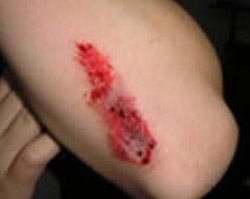 skin abrasion there is a painful and severe abrasion of the skin