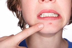 Acne can appear on any oil-producing area of the body