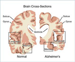 Often early onset in the elderly or old age, disease and more slowly, and gradually progress to dementia as the main performance.