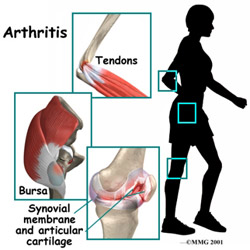 Some of the symptoms of arthritis will include pain in the leg muscles and joints, swelling and tenderness and a cracking sound when you bend your knees.