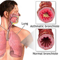 common symptoms are coughing, chest tightening, a shortness of breath, and wheezing