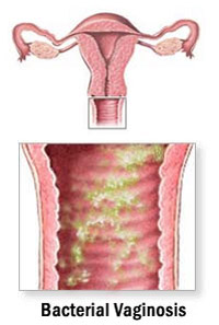 Bacterial Vaginosis is the most common vaginal infection in the world - it is twice as common as yeast infections.
