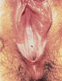 A woman may not realize she has a problem with bacterial in her vagina, as traditional it is thought that there is an obvious smell, but this is not always true.