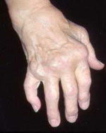 Rheumatoid arthritis in hands
